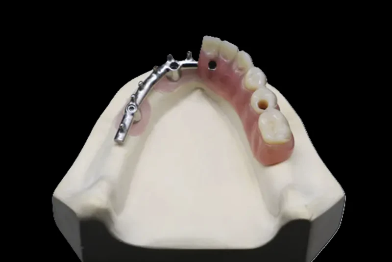 Overdenture Bar